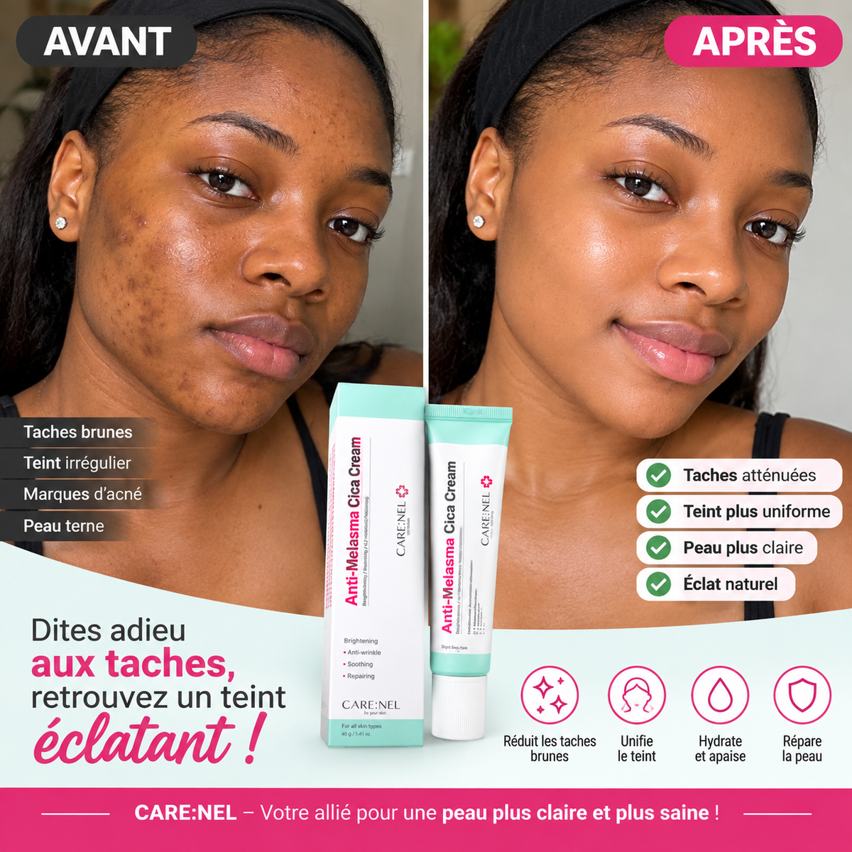 Cream Anti-Melasma — Dites adieu aux taches, bonjour à l'éclat