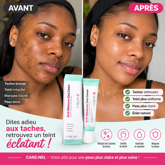 Cream Anti-Melasma — Dites adieu aux taches, bonjour à l'éclat