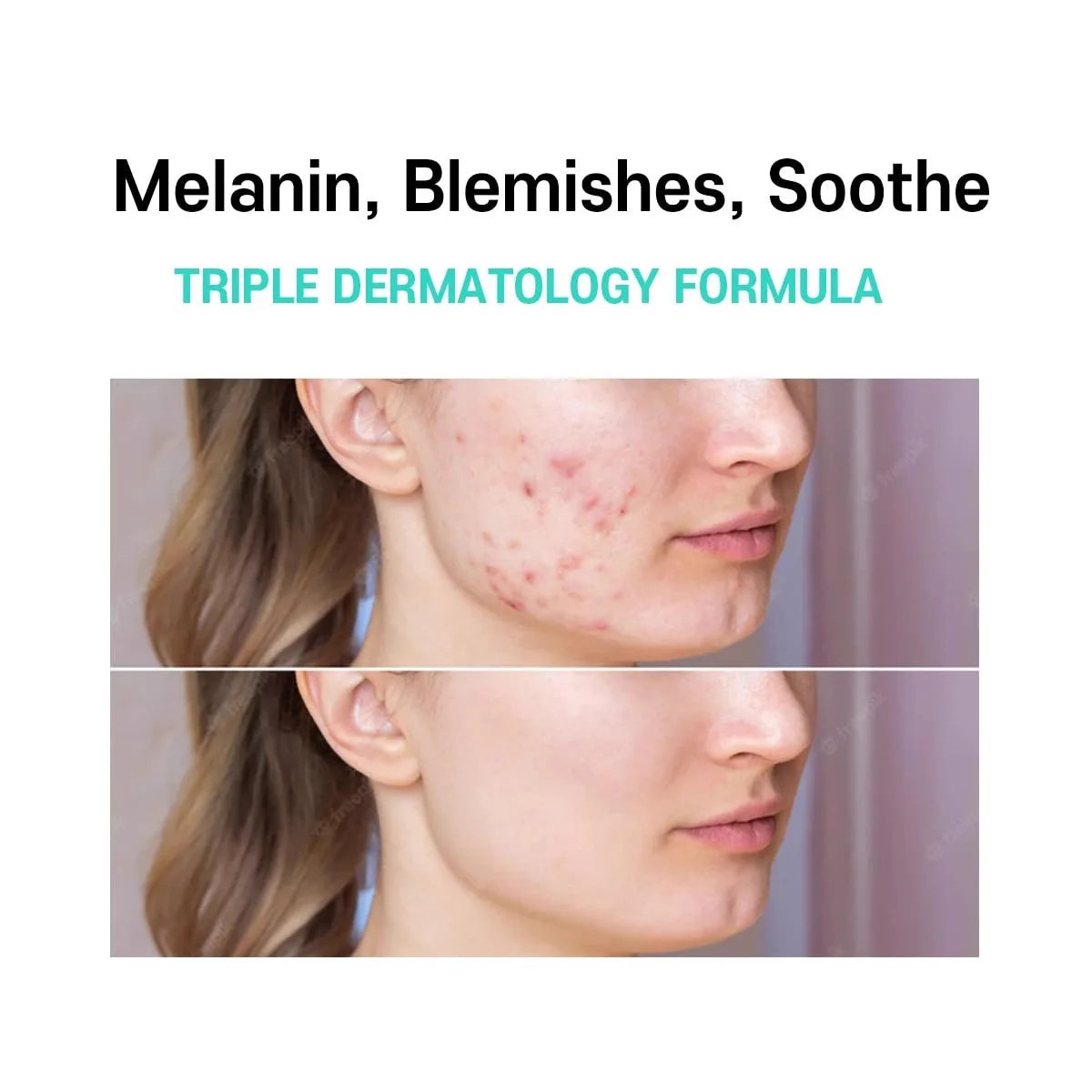 Cream Anti-Melasma — Dites adieu aux taches, bonjour à l'éclat